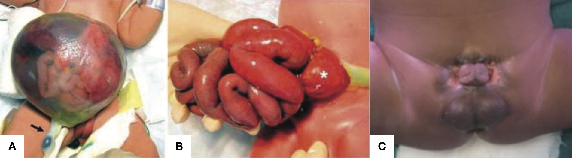 Types of Abdominal Wall Defect
