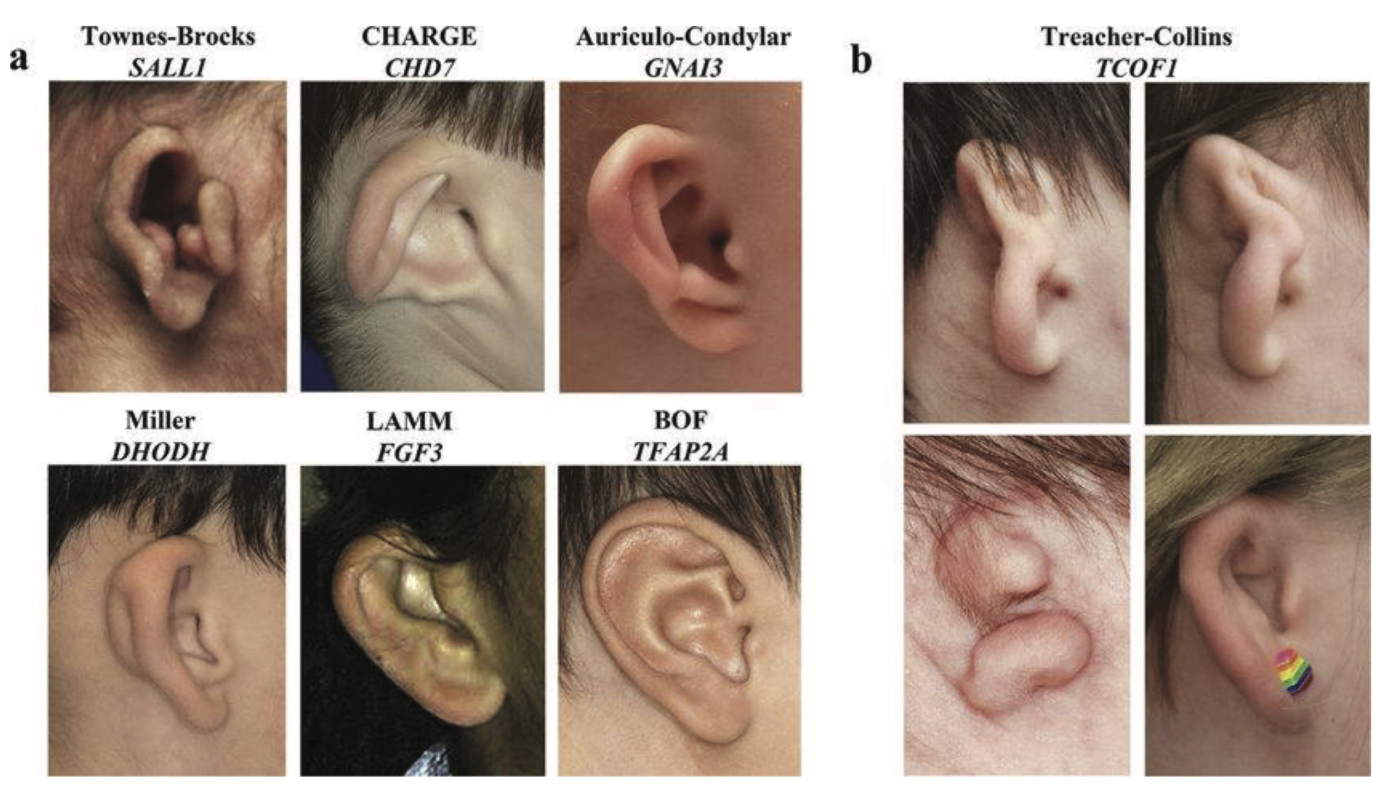 Auricular Malformation and the Associated Gene Mutation