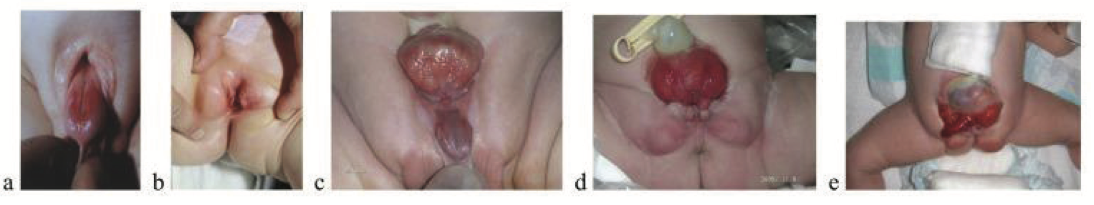 Omphalocele with Disruption of Genitourinary Anatomy