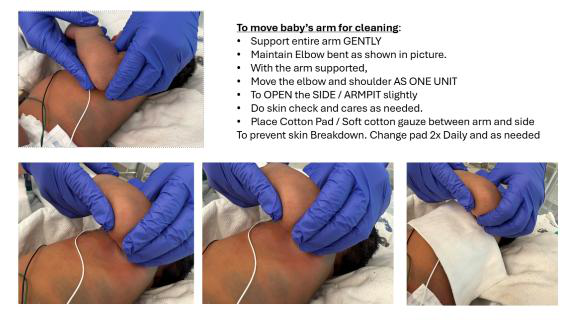 Moving baby’s arm for cleaning (NICU PT).