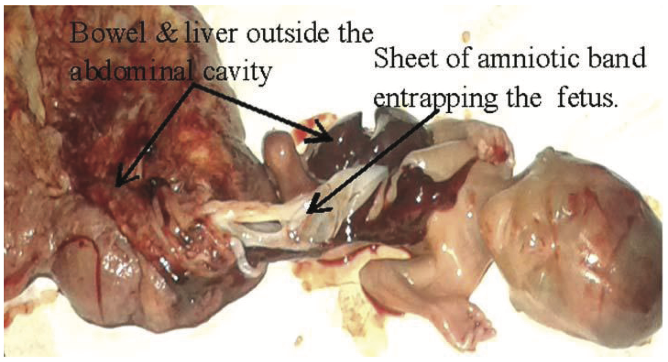 Massive Abdominal Wall Defect