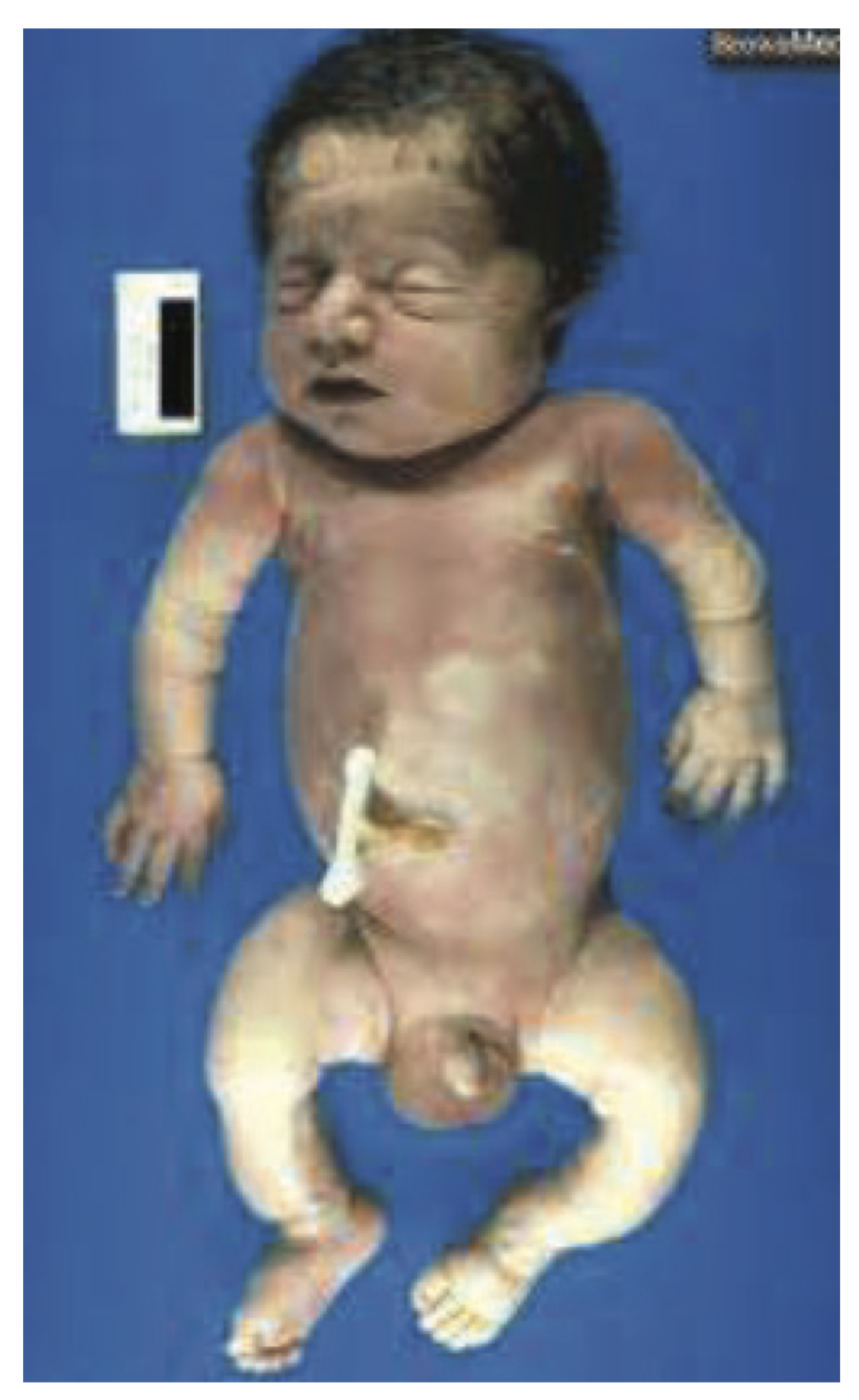 Osteogenesis Imperfecta